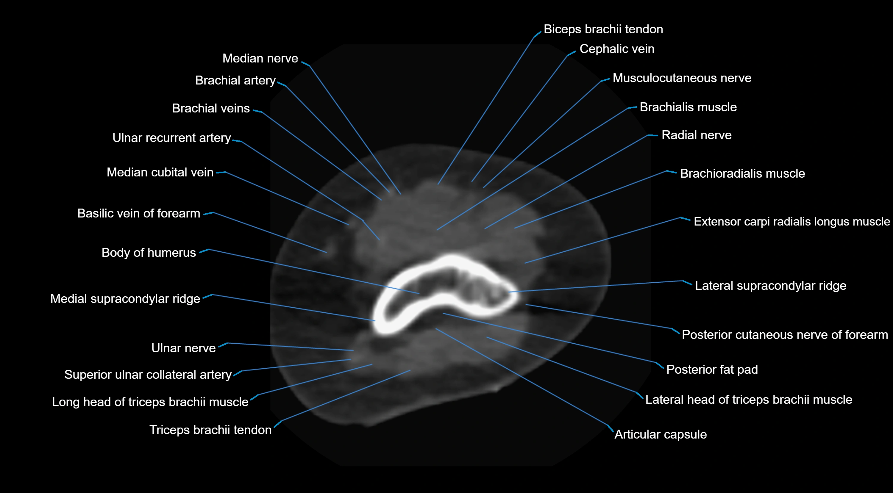CT elbow axial  cross sectional anatomy labelled  radiology image -00011.webp